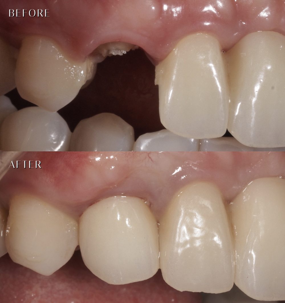 即拔即種植牙 before after