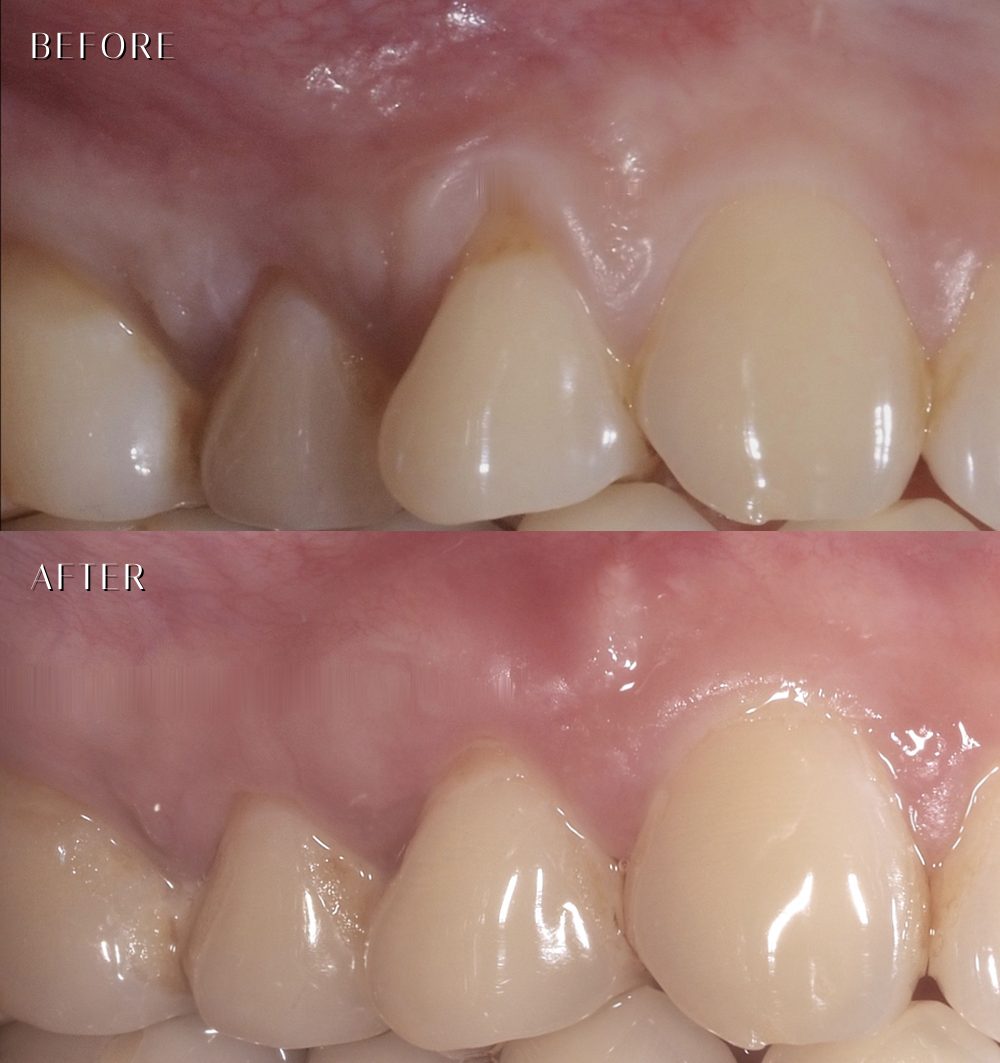 上顎小臼齒牙齦萎縮重建 before after