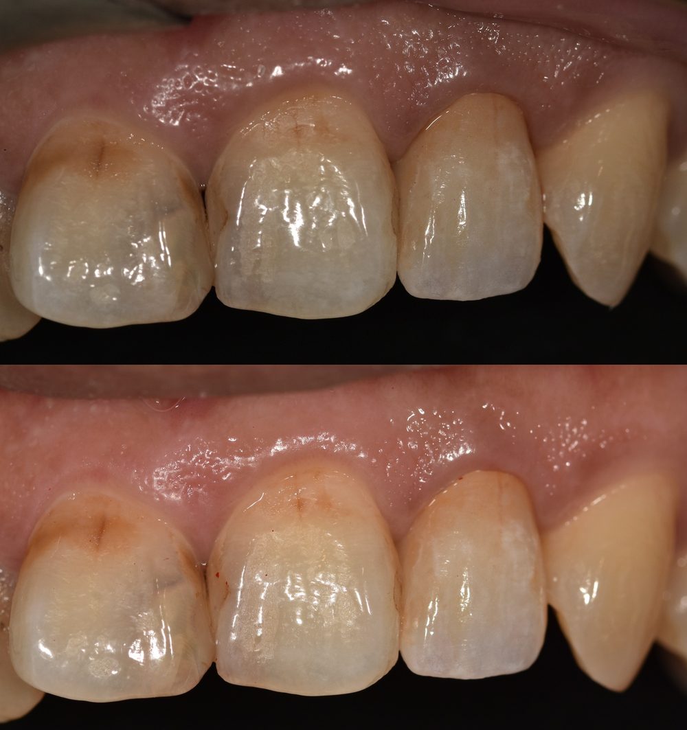 上顎側門牙牙冠 before after